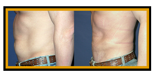 liposuction-abdominal-male.png